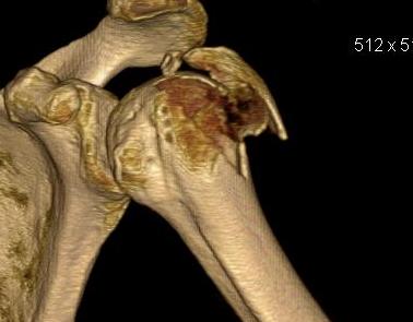 Shoulder CT Displaced GT Fracture